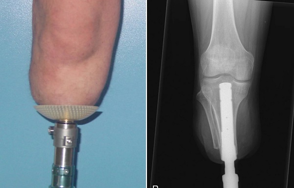 پروتز اسئواینگریشن (Osseointegration)