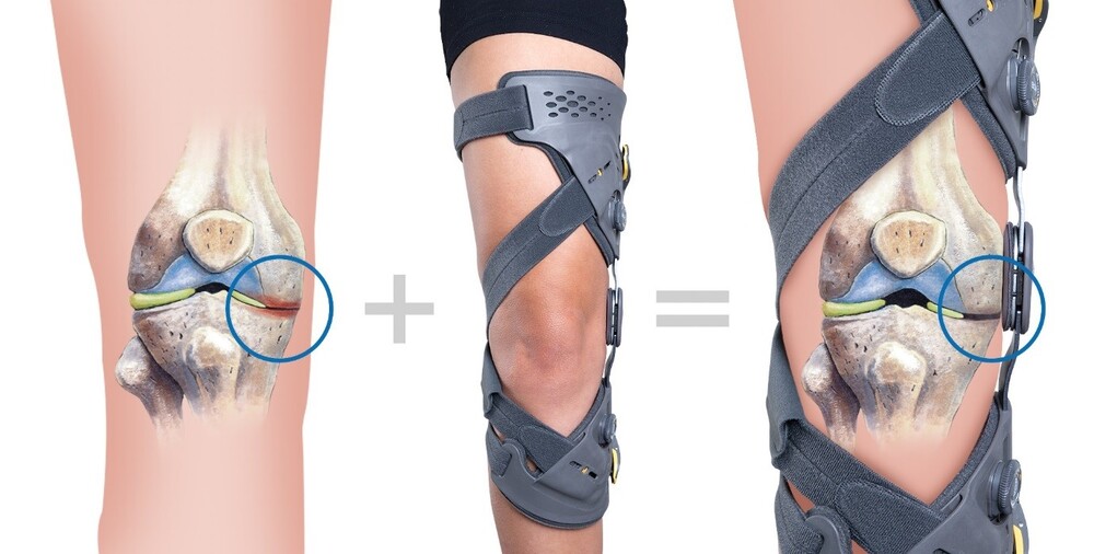 زانوبند طبی آنلودر آفلودر یا تخلیه&zwnj;کننده وزن