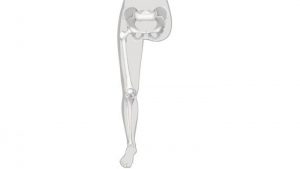 قطع از ناحیه مفصل ران- لگن و همی پلوکتومی (قطع پا از ناحیه لگن)