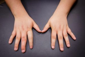 پروتز انگشت قطع شده