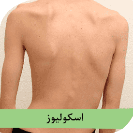 اسکولیوز