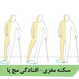 سکته مغزی افتادگی مچ پا