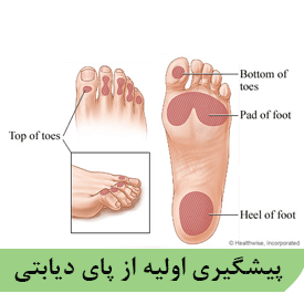 پیشگیری اولیه از پای دیابتی