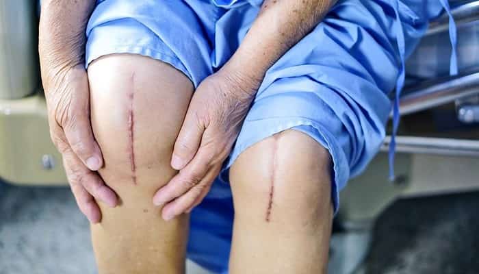 دردهای پس از تعویض مفصل زانو