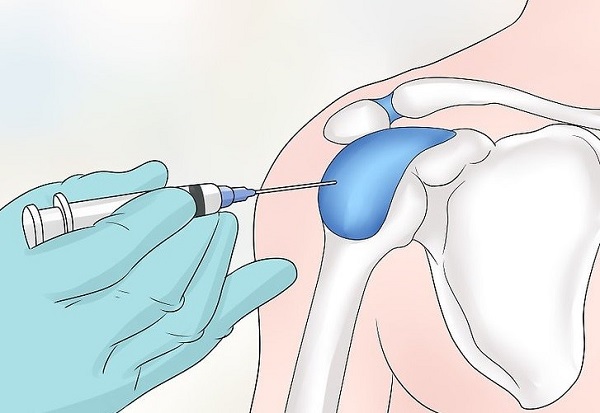 تزریق استروئید برای درمان تاندونیت شانه