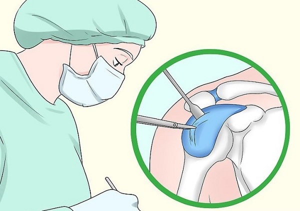 جراحی تاندونیت شانه