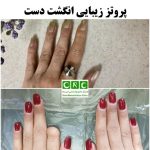 پروتز زیبایی انگشت دست