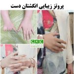 پروتز زیبایی انگشتان دست
