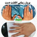 پروتز زیبایی انگشت دست