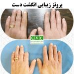 پروتز زیبایی انگشت دست