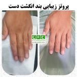 پروتز زیبایی انگشت دست