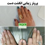 پروتز زیبایی انگشت دست