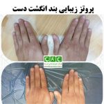 پروتز زیبایی بند انگشت دست