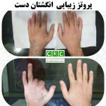 پروتز زیبایی انگشتان دست