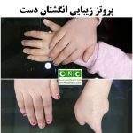 پروتز زیبایی انگشت دست