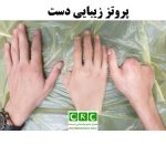 پروتز زیبایی دست