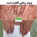 پروتز زیبایی بند انگشت دست