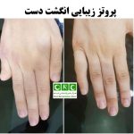 پروتز زیبایی انگشت دست