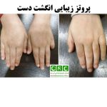 پروتز زیبایی انگشت دست