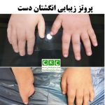 پروتز زیبایی انگشت دست